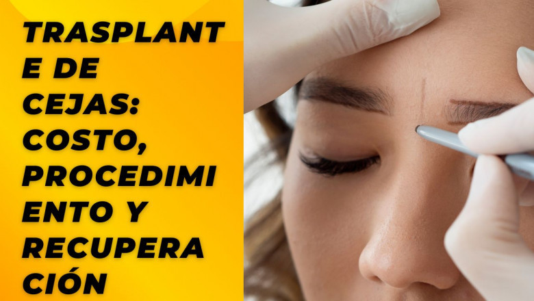 Trasplante de Cejas: Costo, Procedimiento y Recuperación
