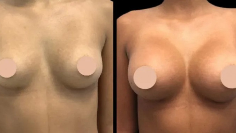 How to Choose the Perfect Size and Shape for Your Breast Augmentation with the Best Doctors in Dubai