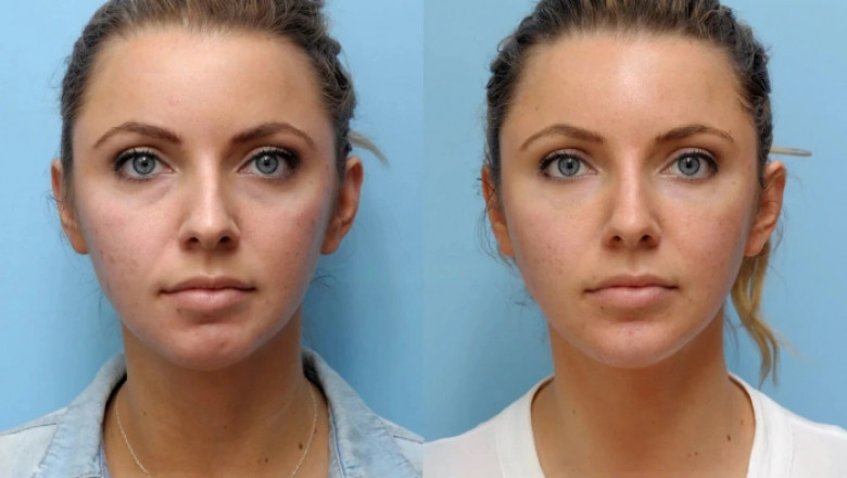 Is Thread Lift Treatment in Dubai the Solution to Aging Skin