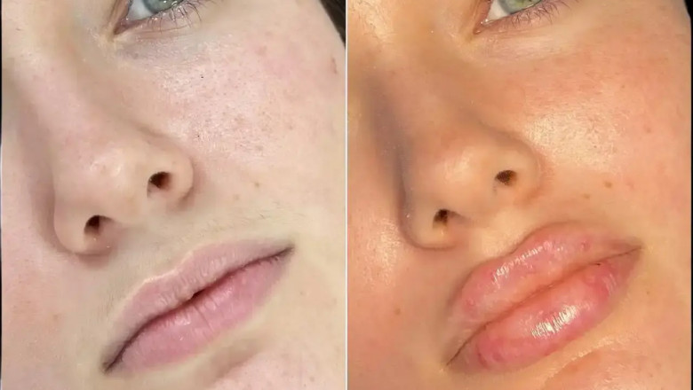 Best Aesthetic Clinic in Dubai for Fillers That Prioritizes Safety