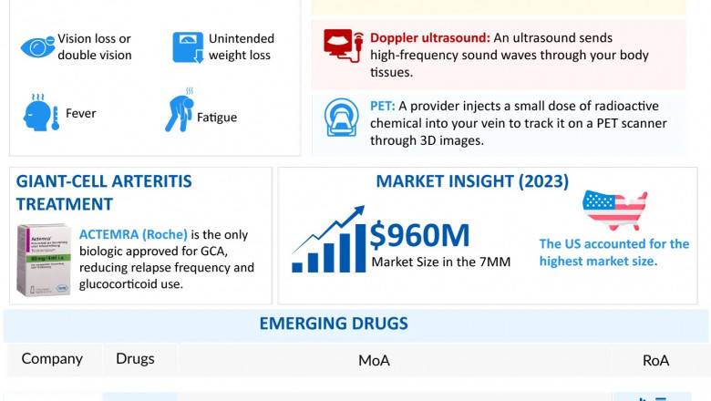 Overview of Giant Cell Arteritis (GCA)