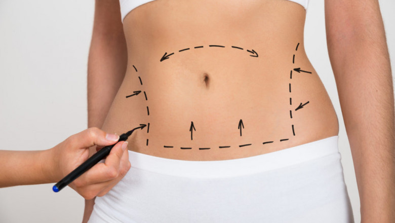 Exclusive Liposuction Tips from Best Liposuction Surgeon in Dubai