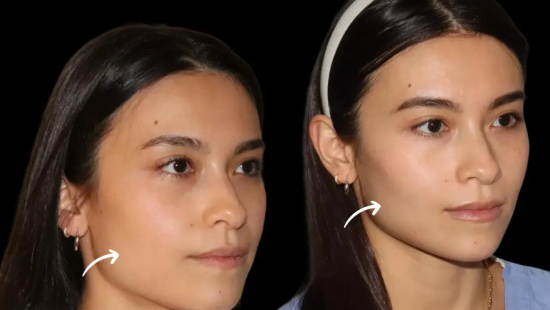 Unlock Your Ideal Face: Try Sculptra Fillers at the Best Aesthetic Clinics in Dubai