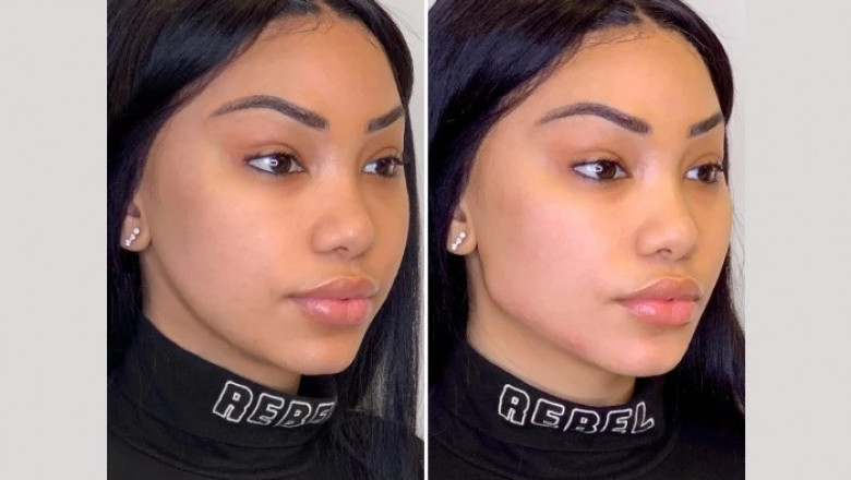Why the Best Aesthetic Clinics in Dubai Recommend Thread Lift for Facial Rejuvenation