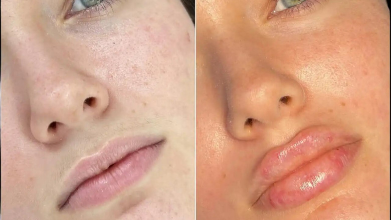 How Fillers in Dubai Can Help You Achieve a Balanced Face Shape