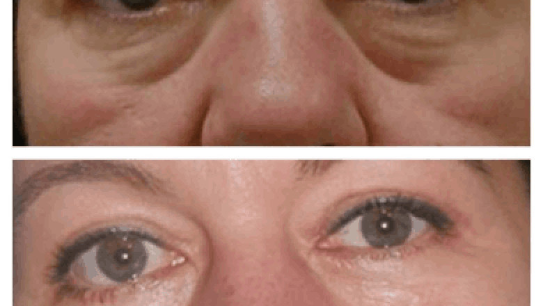 How the Best Doctors in Dubai Ensure Safety During Eye Bag Removal