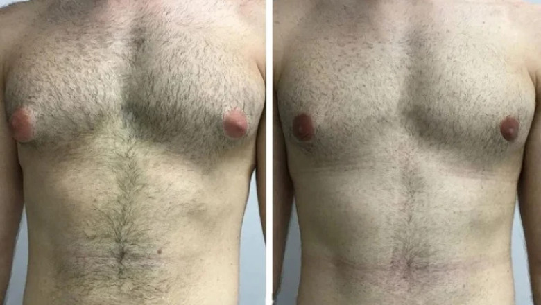 How the Climate Affects Post-Surgery Healing from Gynecomastia in Dubai