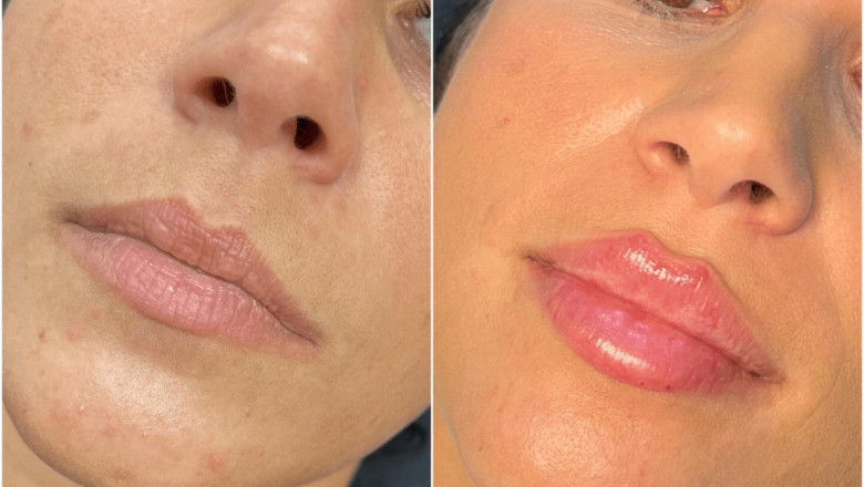 Volume Loss? Try Juvederm treatment in Dubai