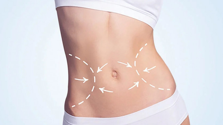 Abdominoplasty in Dubai: How to Prepare for Your Abdominoplasty Procedure