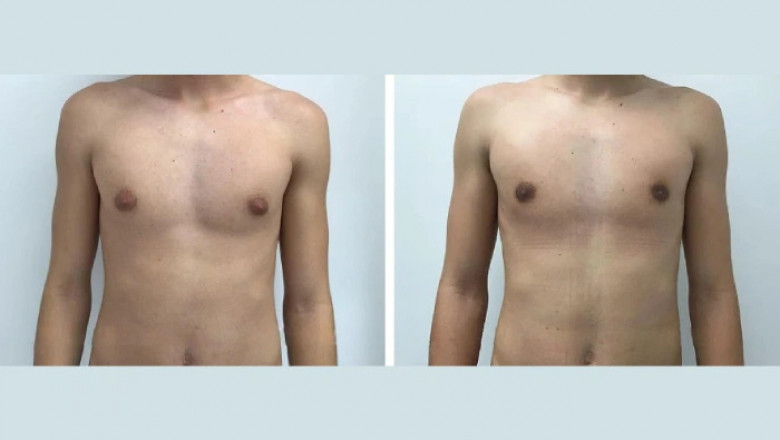 Gynecomastia Surgery in dubai: Step-by-step Guide