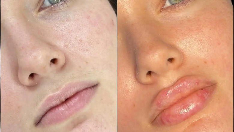 Experts Recommend These Best Doctors in Dubai for Fillers