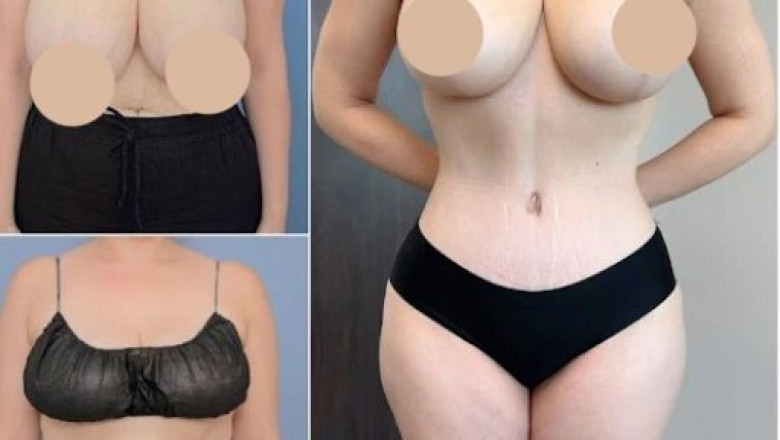How the Best Tummy Tuck Surgeons in dubai Achieve Long-Lasting Results