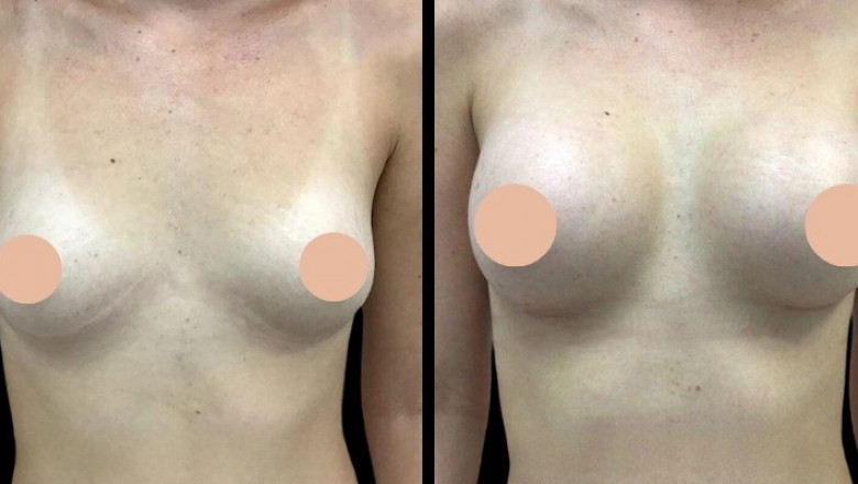 Best Doctors in Dubai Discuss the Latest Advances in Breast Augmentation Techniques
