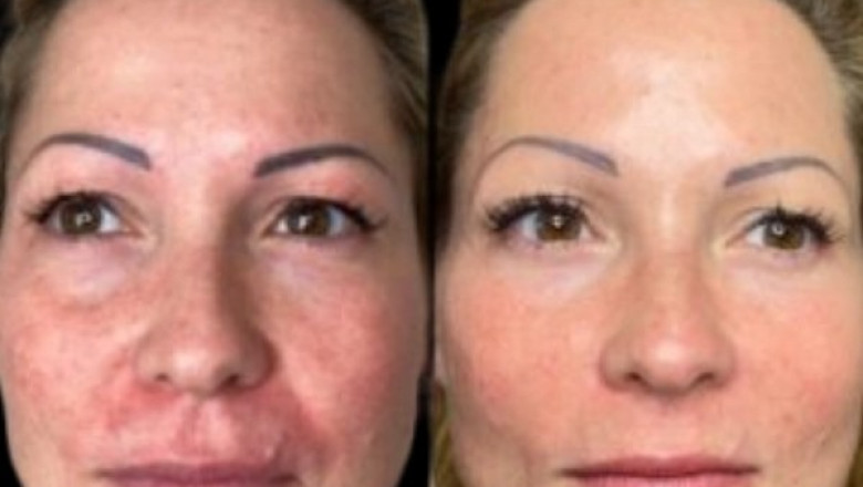 Revamp Skin Tone with Profhilo at Best Aesthetic Clinic in dubai