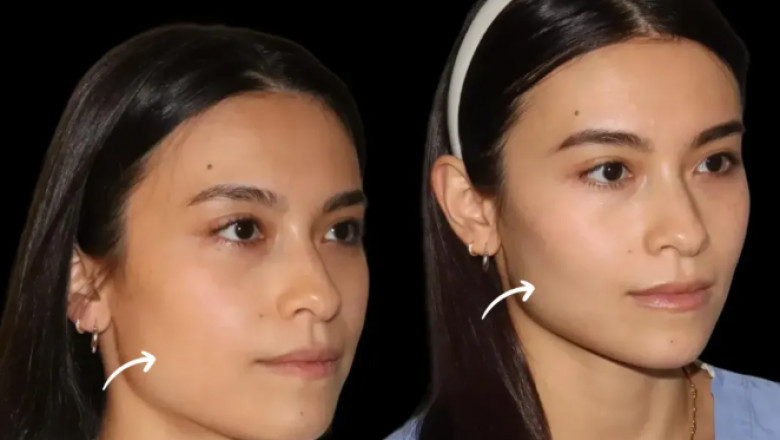 Post-Treatment Care for Sculptra Fillers by Dubai’s Best Aesthetic Clinics