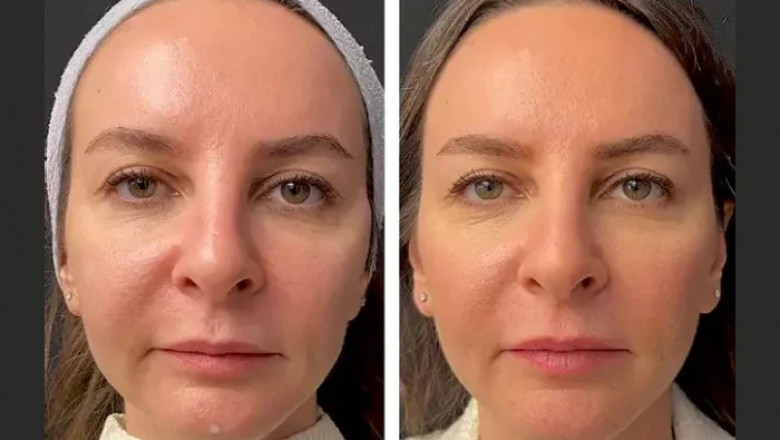 The Science Behind Mesotherapy in Dubai: How It Works