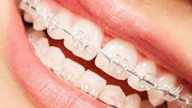 What Happens If You Skip Braces Appointments?