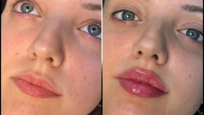 Your Guide to Choosing the Best Plastic Surgeon in dubai for Fillers and Jawline Sculpting