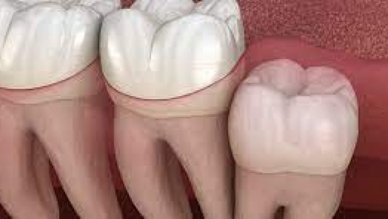 Local vs. General Anesthesia for Wisdom Tooth Surgery