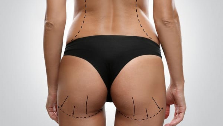 Butt Fat Transfer Surgery in Dubai: A Safe and Natural Alternative to Implants