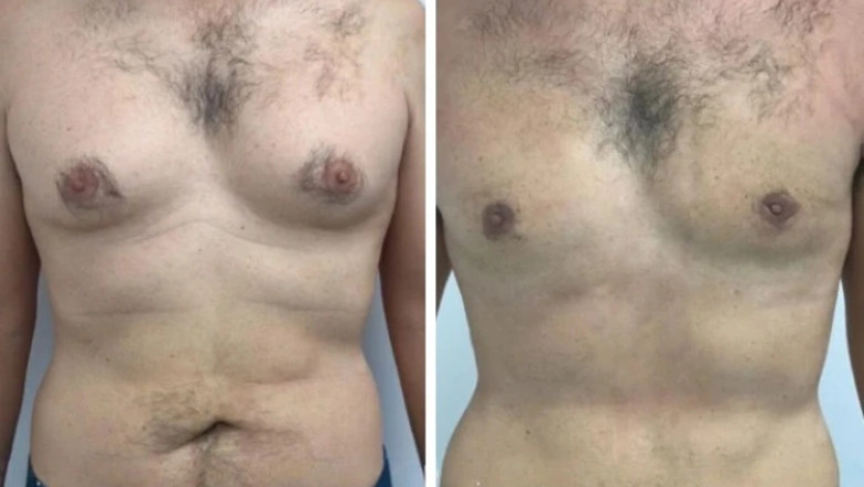 Understanding the Emotional Benefits of Gynecomastia Surgery in dubai