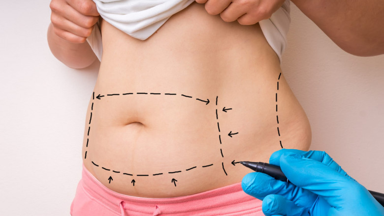 Mommy Makeover in Dubai: How a Tummy Tuck and Liposuction Work Together in a Mommy Makeover