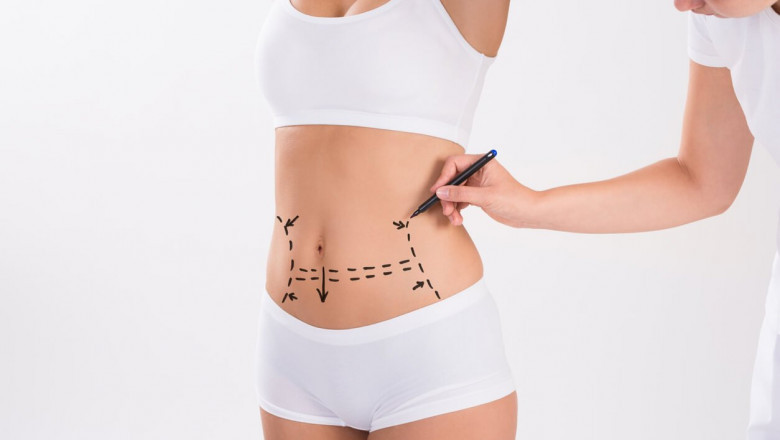 What I Wish I Knew Before Getting Liposuction