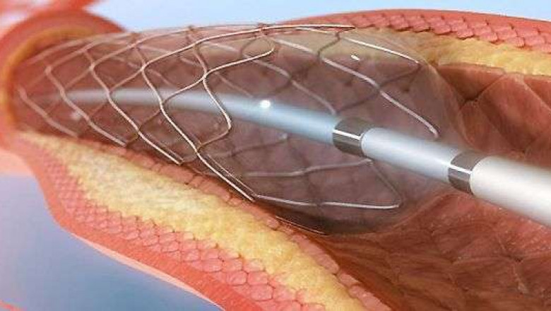 Percutaneous Transluminal Angioplasty Balloons Catheter Market to Soar on Rising Cardiovascular Disease Prevalence
