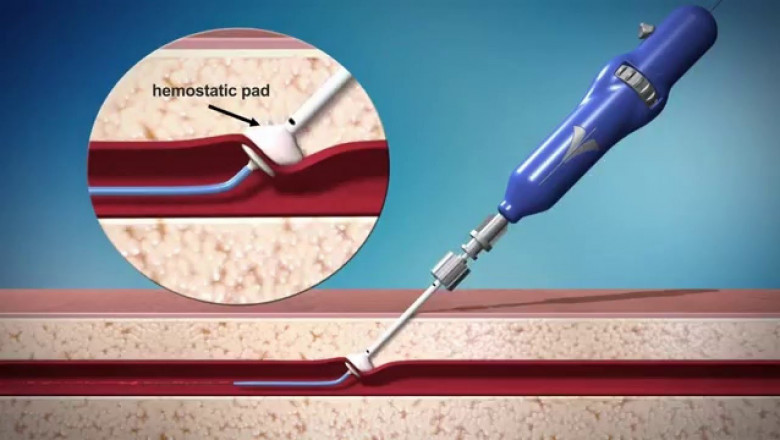 Vascular Closure Device Market Growth and Innovations