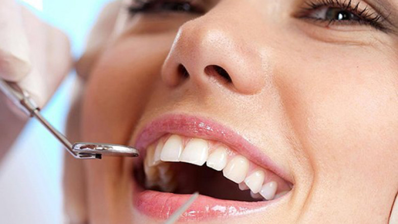 Root Canal Removal in Tampa: Understanding the Procedure, Benefits, and Aftercare