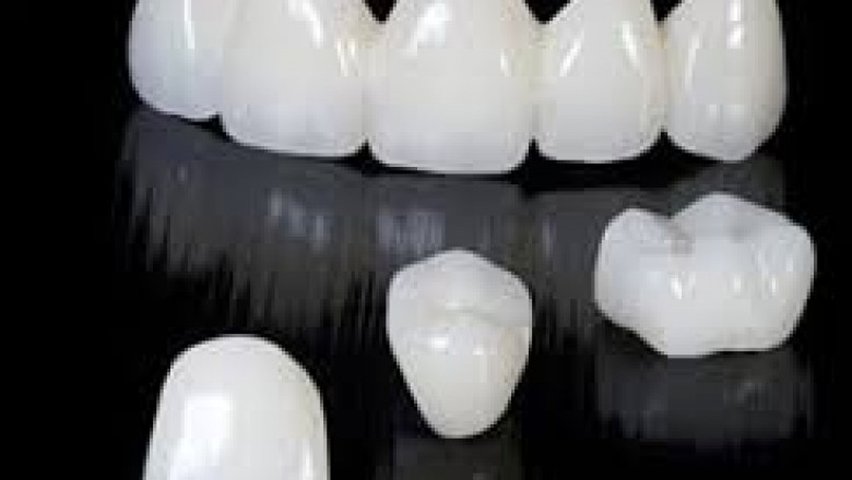 Exploring the Benefits and Advancements of All Ceramic Dental Crowns